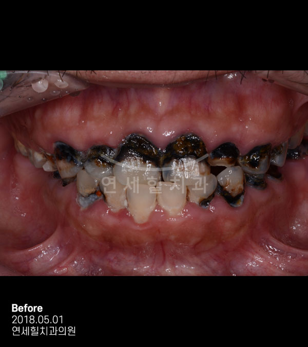 implant before 症例10 韓国 ヨンセヒール歯科