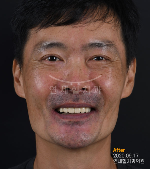 implant after 症例4 韓国 ヨンセヒール歯科
