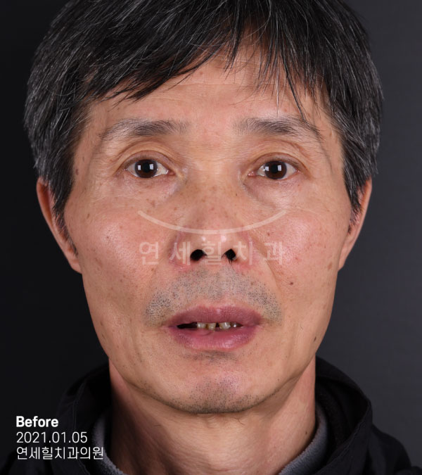 implant before 症例7 韓国 ヨンセヒール歯科