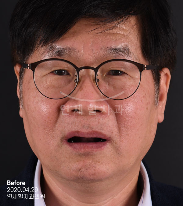 implant before 症例8 韓国 ヨンセヒール歯科